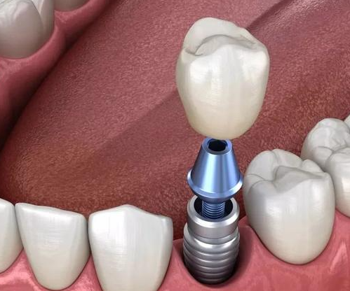 价格调控，内蒙古单颗牙种植医疗费用整体降一半